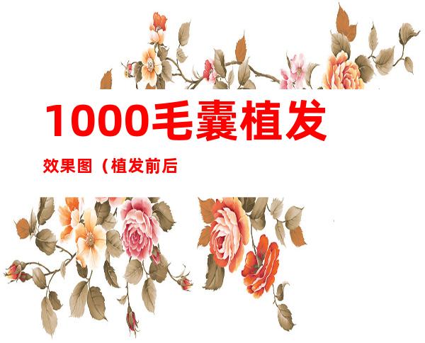 1000毛囊植发效果图（植发前后效果对比照）